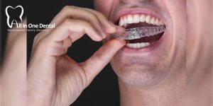 5 Amazing Benefits Of Getting Invisalign