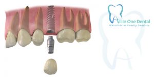 Things You Need To Know About Dental Implants