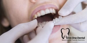 Advantages Of Invisalign Over Traditional Braces
