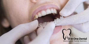 Advantages of Invisalign Over Traditional Braces