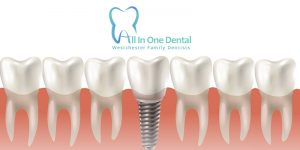 All You Need To Know About All On   Implants Overdenture