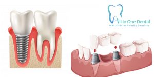 Dental Implants Vs Crowns: Which Is Better?