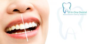 How does Teeth Whitening Work