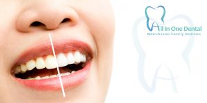 How Does Teeth Whitening Work?