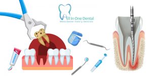 Root Canal Treatments Vs  Tooth Extraction: Which Is More Effective?
