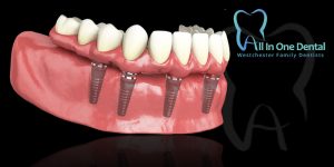 Why Replace Missing Teeth With Dental Implants