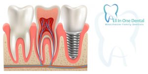 Wisdom Tooth Extractions:   Facts You Need To Know