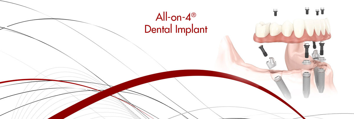 Los Angeles All-on-4 Dental Implants