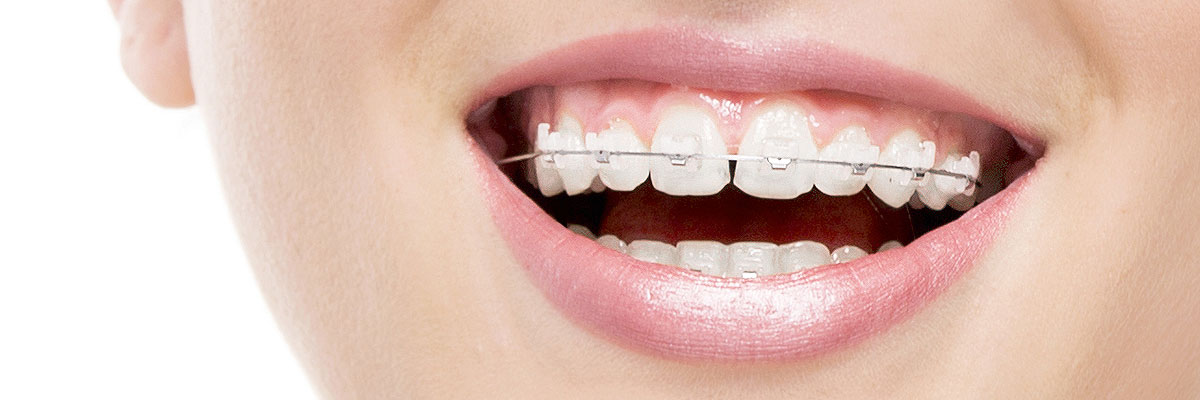 Los Angeles Invisible Orthodontics