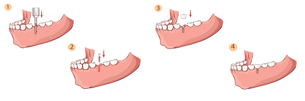 Los Angeles The Dental Implant Procedure