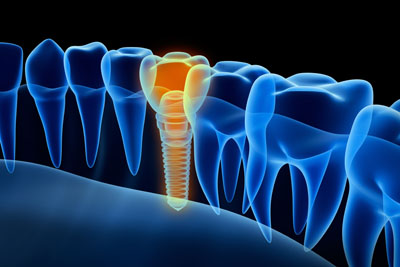 All On Four Dental Implants Can Replace Your Teeth In Time For Your Child’s Wedding