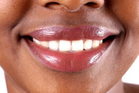 Snap-On Smile
