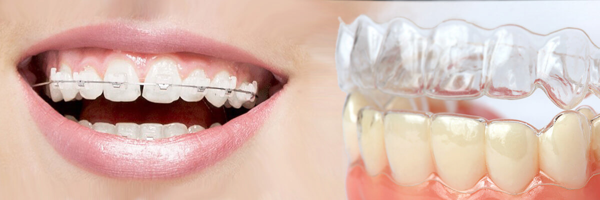 Los Angeles Which is Better Invisalign or Braces